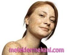 Çil tedavisi için bitkisel öneriler cill bitkisel tedavisi1 5525 Çil tedavisi için bitkisel öneriler