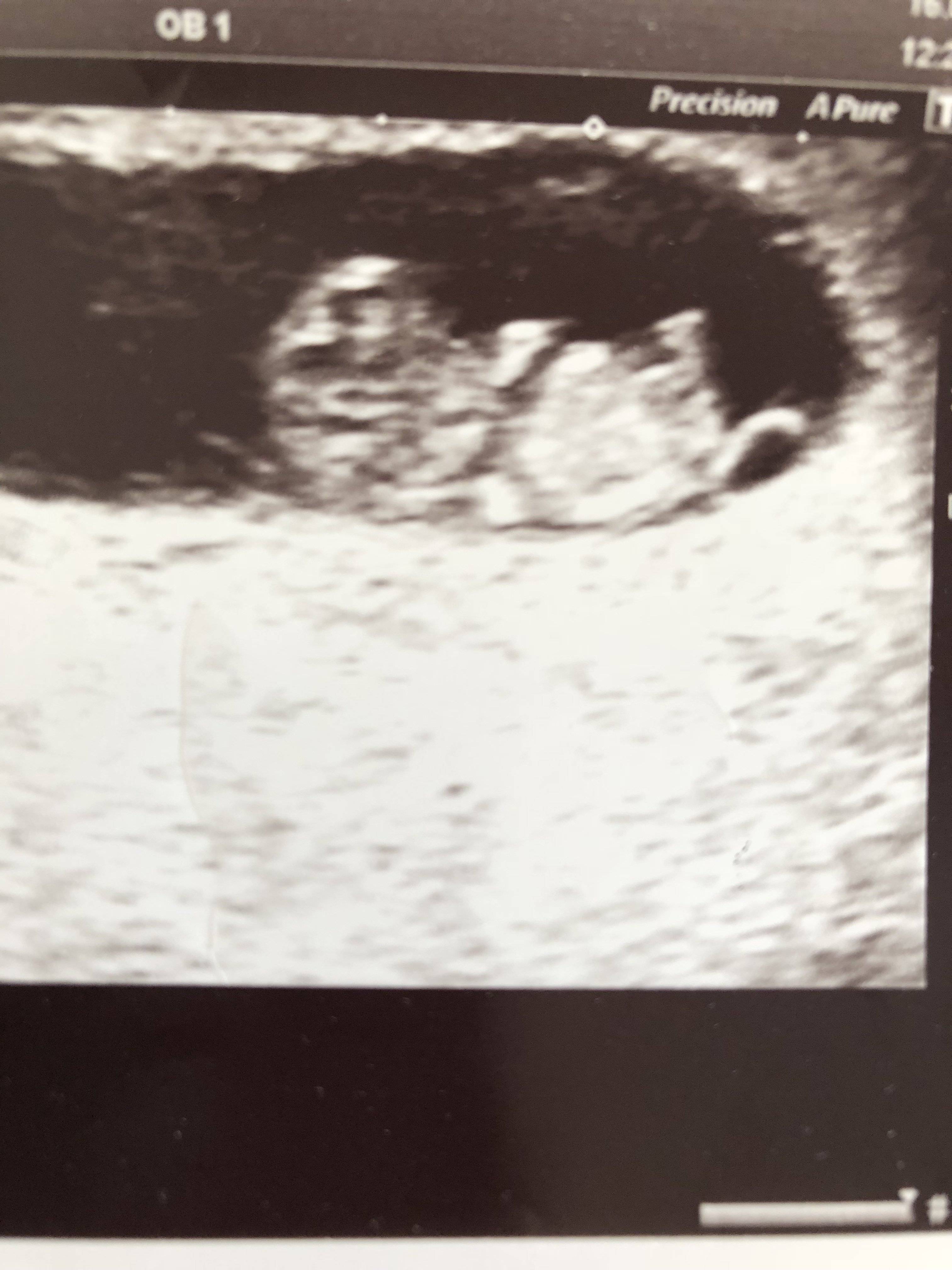 9 haftalık gebeyim ultrason görüntüsüne göre bebeğimin