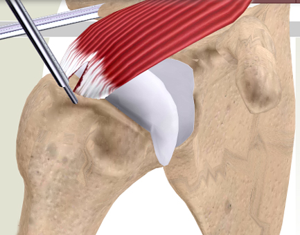 Kol Kası Yırtılması