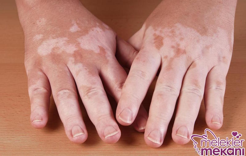 Addison hastalığı.jpg