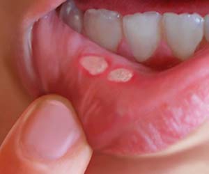 Agiz-yaralarina-aft-ya-da-agiz-ulseri-de-denir.jpg
