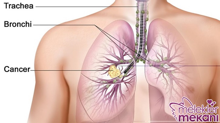 akciğer kanseri.jpg