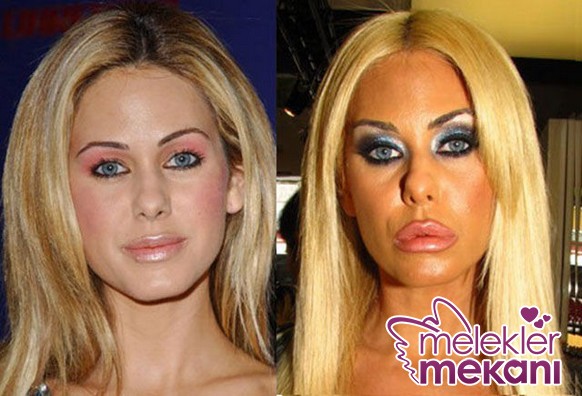 celebrity_surgeries_that_didnt_end_well_640_22.JPG