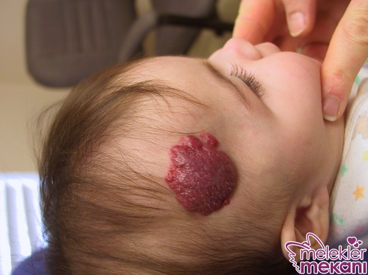 Çilek Hemanjiyomları.jpg