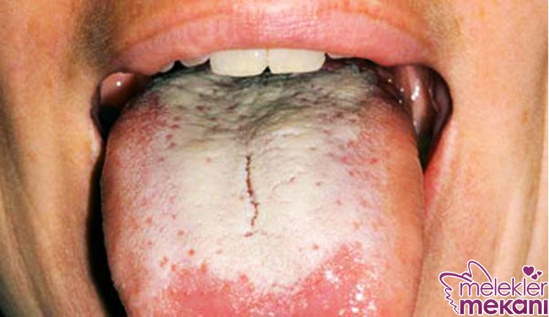 dilde beyazlık.jpeg