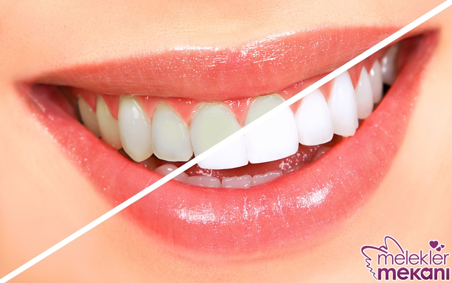 diş beyazlatma.jpg