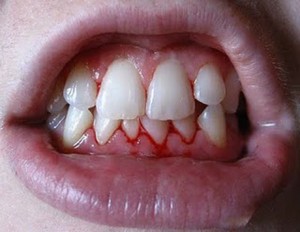 dis_eti_kanamasi-diş-etleri-hastalıkları.jpg