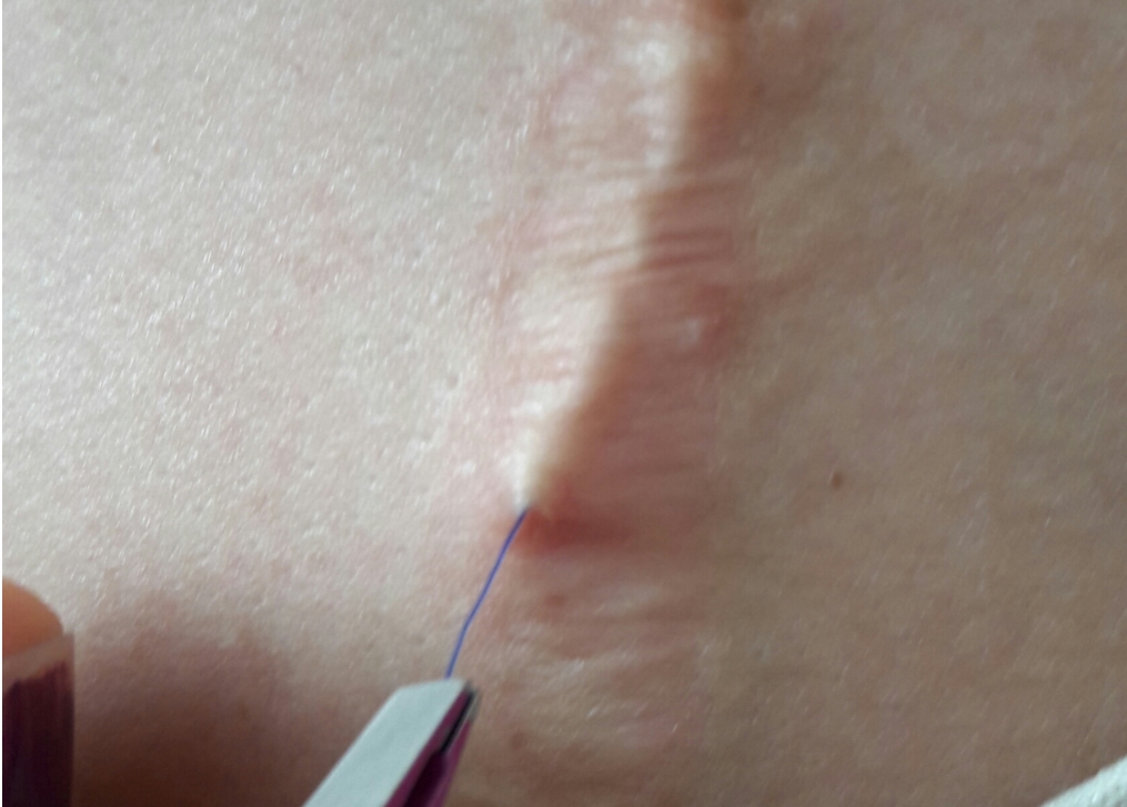 doğum dikiş ipi görünüyor.jpg