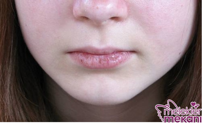 dudak çatlaması.jpg