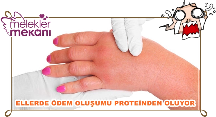 el ayak şişmesi ödem belirtileri nelerdir.jpg