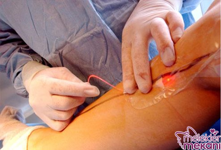 Endovenöz Lazer.jpg