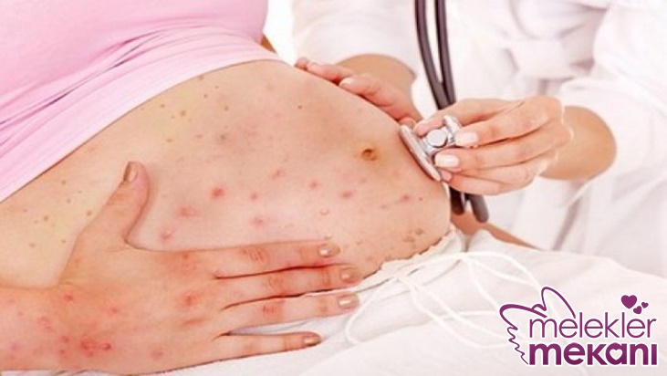 gebelikte su çiçeği zona belirtileri.jpg