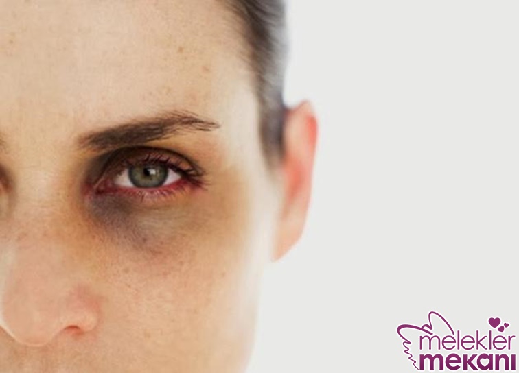 göz altı morluğu.jpg