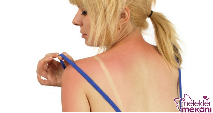 güneş yanığına ne iyi gelir.jpg