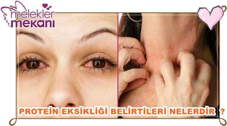 günlük protein eksikliği nasıl anlaşılır.jpg