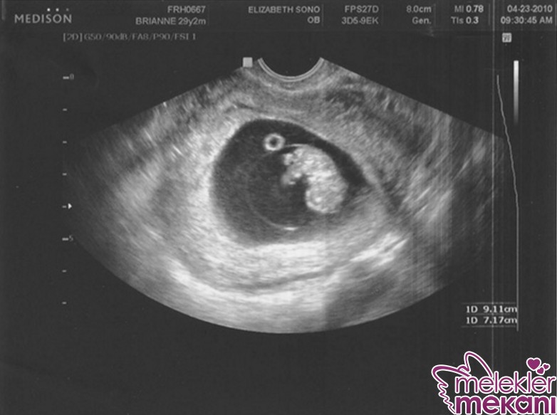 hamilelikte yumurtalik kisti zararli mi.jpg