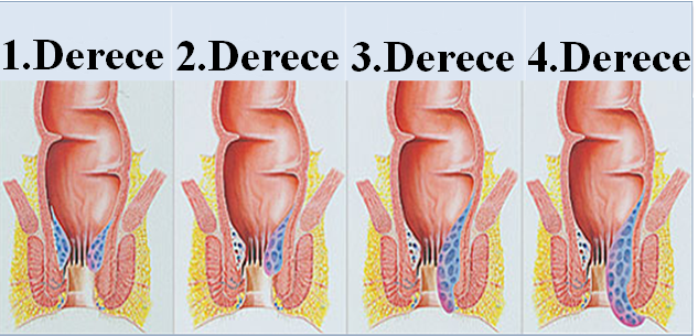 hemoroid belirtileri 2.png