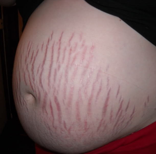 karın çatlağı.jpg