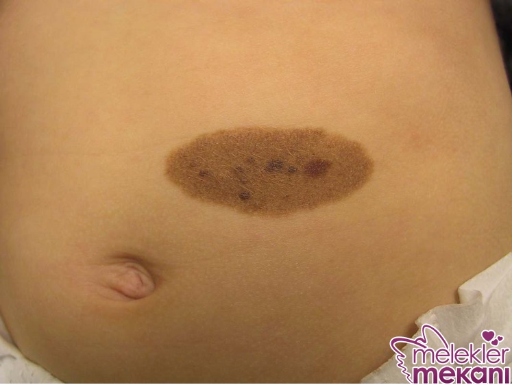 Konjenital nevüs.jpg