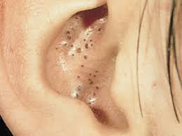 Kulaktaki-Siyah-Noktalar-Nasıl-Giderilir (1).jpg