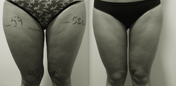 lazerlipoliz yaptıranlar.jpg