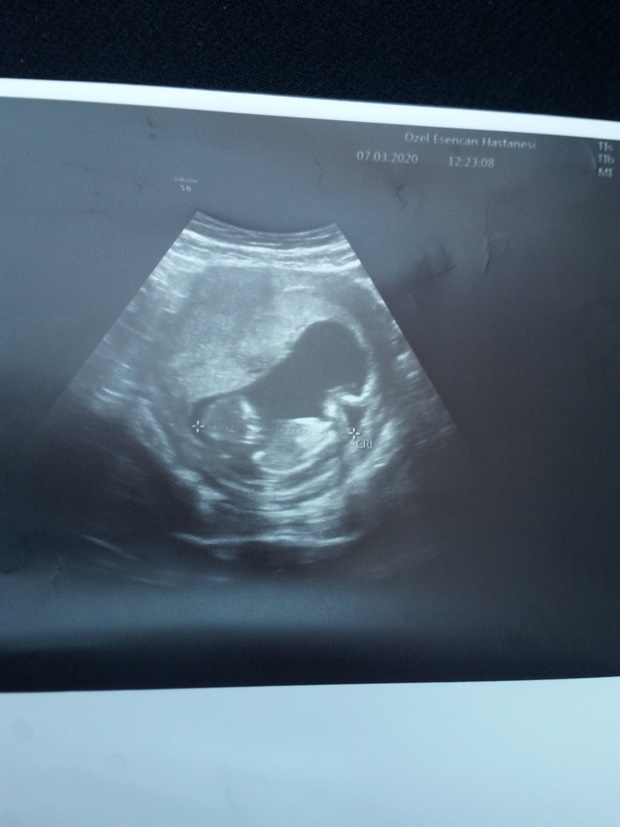 nub cinsiyet tahmini.jpg