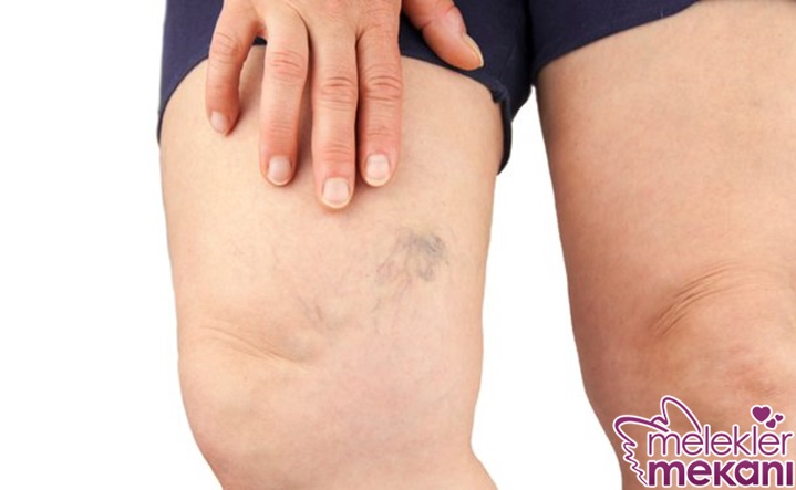 Örümcek damar 2.jpg