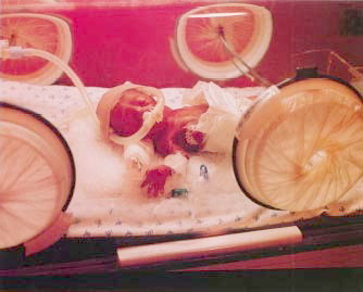 premature-bebek_ (2).jpg