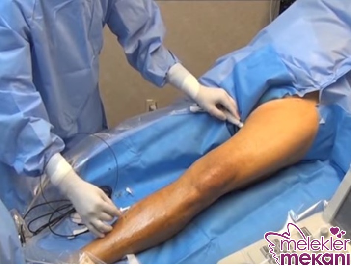 Radyofrekans Ablasyon.jpg