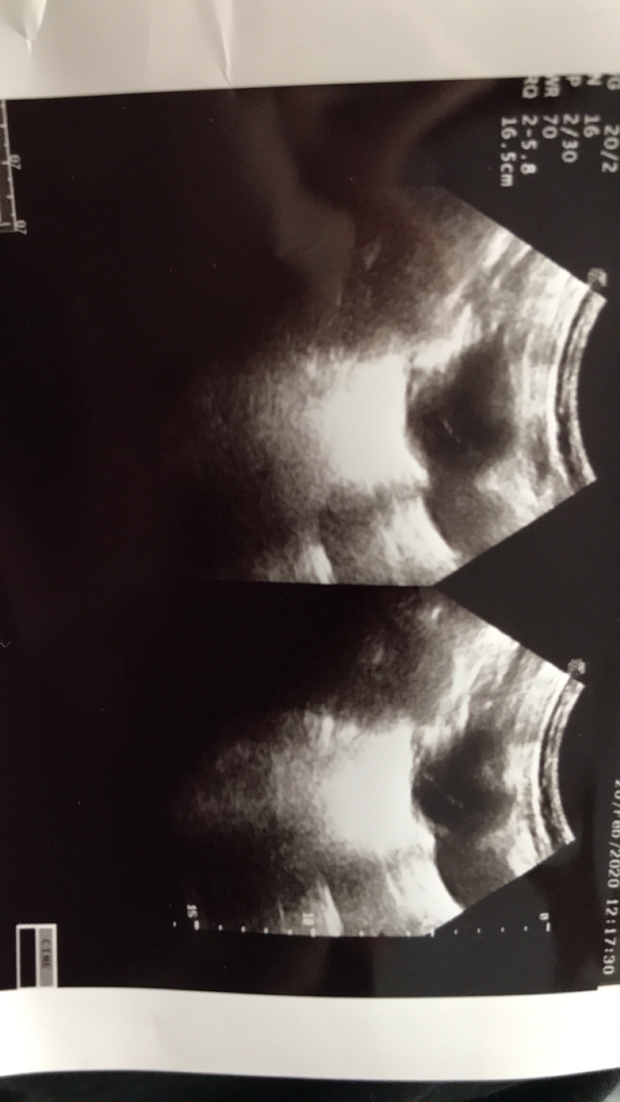 rahimde kist olanlar.jpg