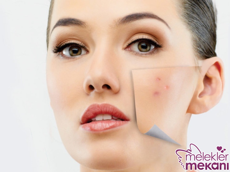 sivilce ve akne tedavisi.jpg