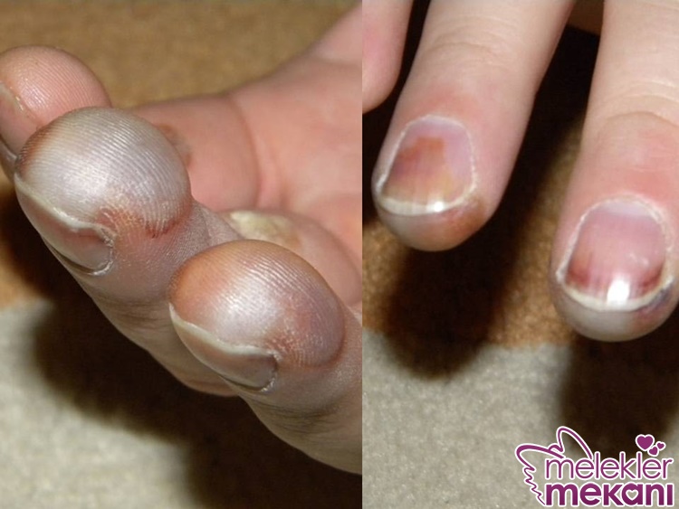 soğuk yaralanması nedir.jpg