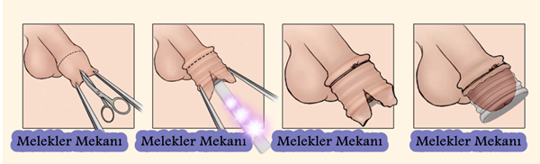 sünnet derisi bakımı.png