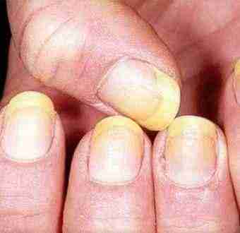 tirnak sararmasi.jpg