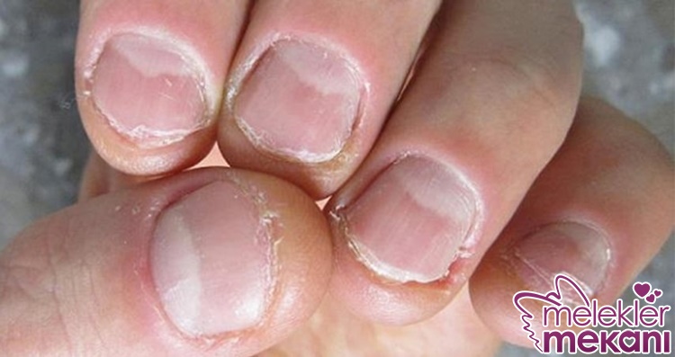 tırnak yemeyi engellemenin yolları.jpg