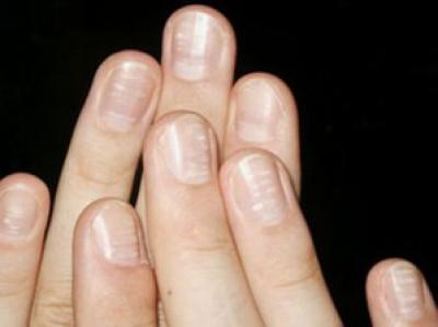 tirnakta beyaz leke.jpg