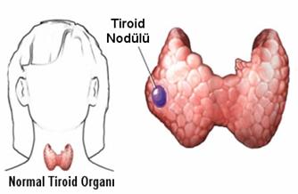tiroid-nodulu.jpg