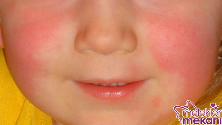 tokatlanmış yanak sendromu.jpg