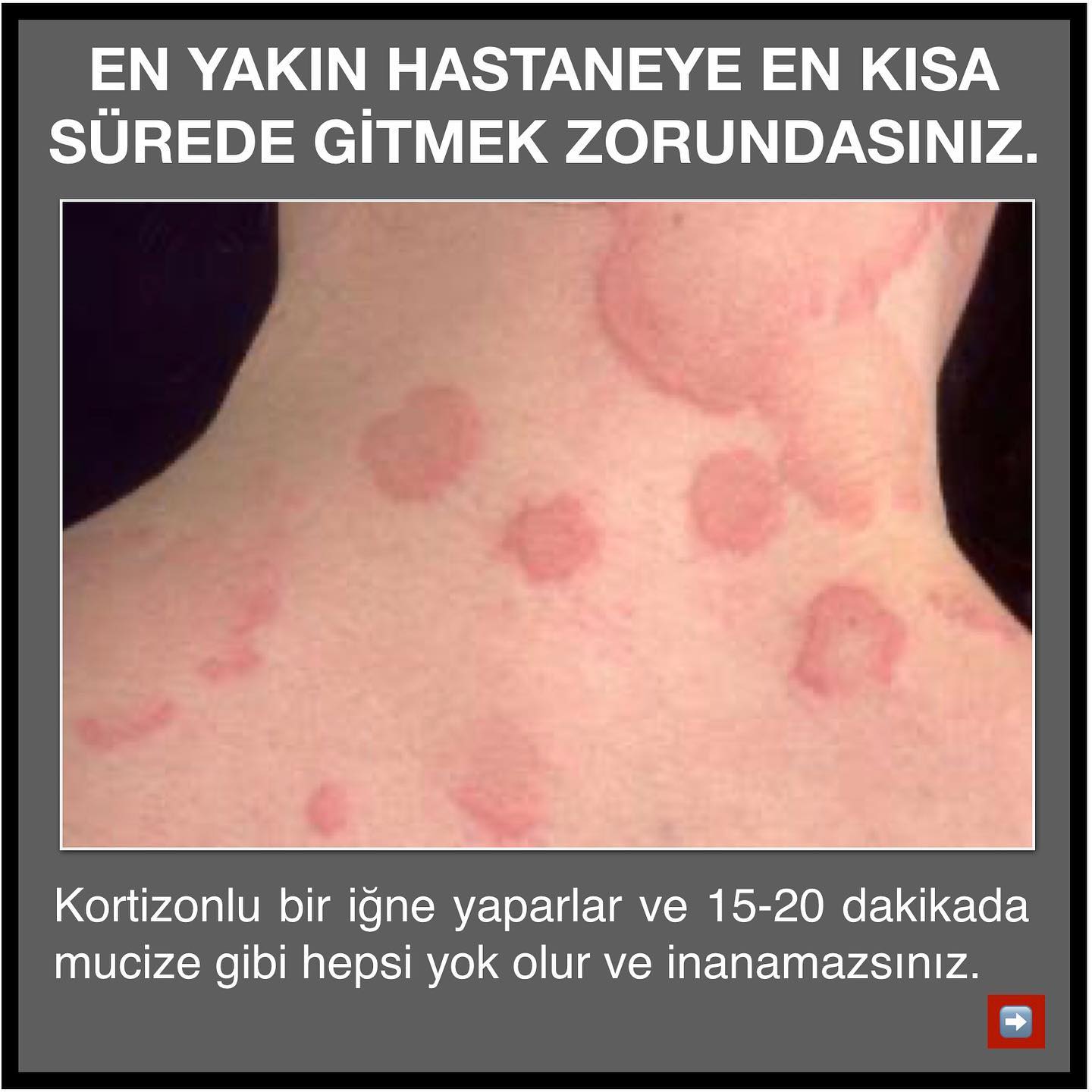 ürtiker kortizon.jpg