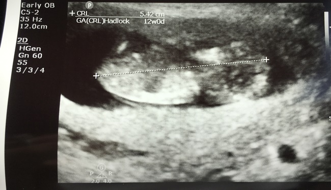 usg cinsiyet tahmini.jpg