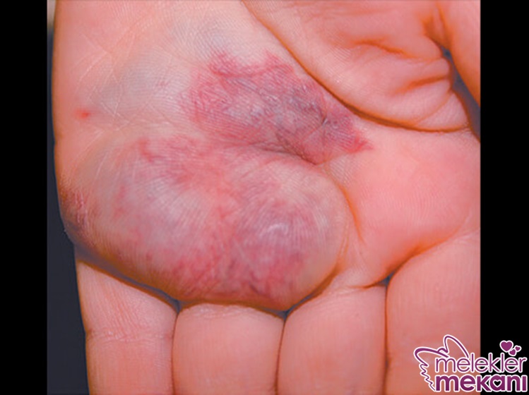 Venöz Malformasyon.jpg