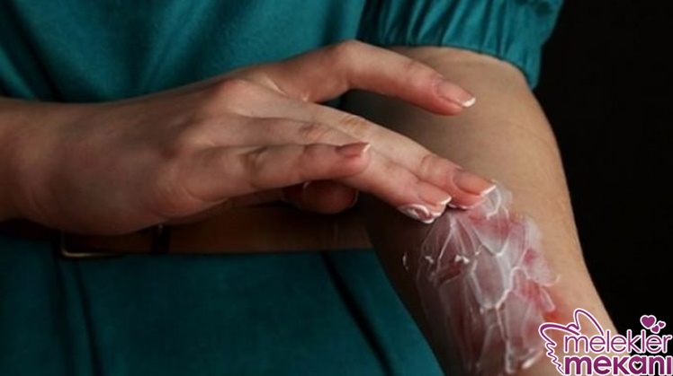 yanık tedavisi.jpeg