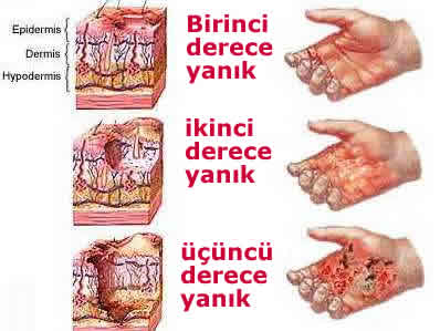 yanik tedavisi yanik cesitlerine gore melek kadinlar kulubu