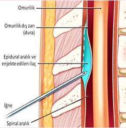 epidural1-5307.jpg