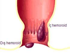 hemoroid-298.jpg