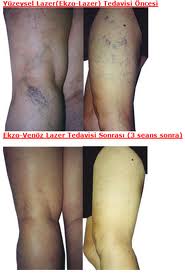 lazerle%20varis%20tedavisi-33e.jpg