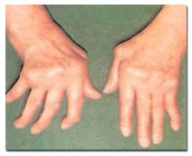 romatoid-artrit-1371.jpg