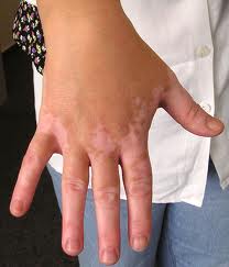 vitiligo-146.jpg