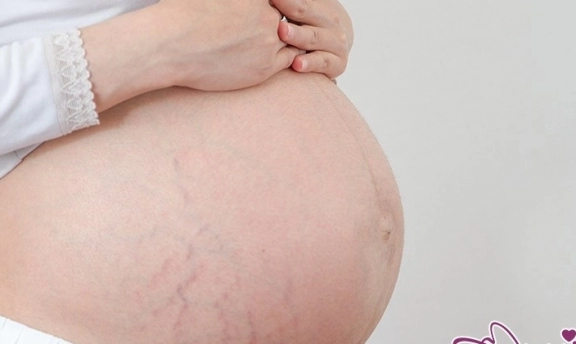 Gebelikte Cilt Çatlaklarını Önlemenin Bir Yolu Var mı?