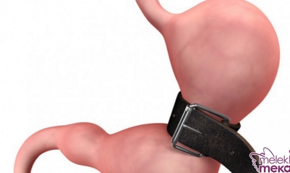 Zayıflama Ameliyatı Herkese Yapılır mı? Zararları Var mı?